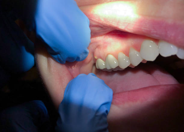 Best Emergency Dental Care for Broken or Chipped Teeth in Meadowood, PA